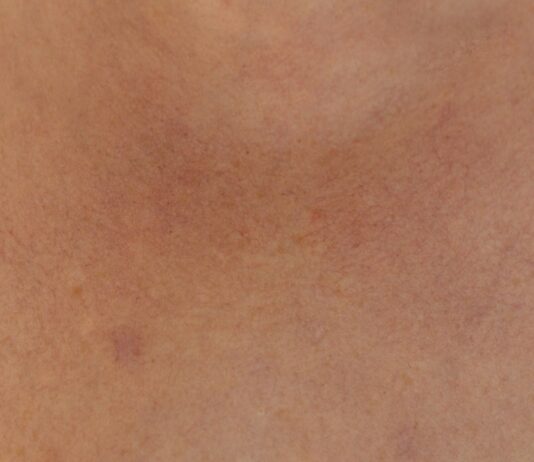 “자꾸 멍이 들어요”… 나도 모르게 생긴 멍, 왜 반복될까? a close up of a person's back with acne on it